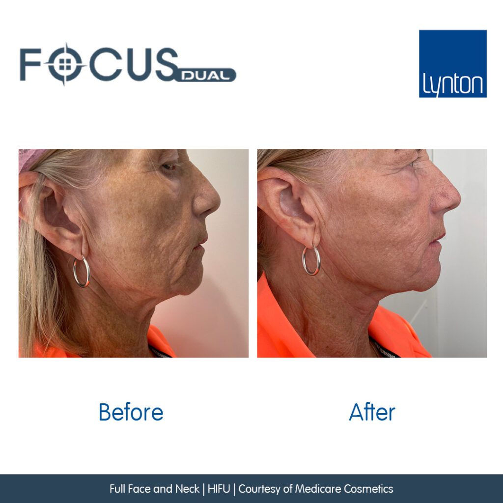 Before and After. Focus Dual. Full Face and Neck. HIFU. Medicare Cosmetics