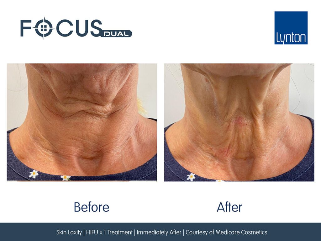 Before and After. Focus Dual. Skin Laxity HIFU Medicare Cosmetics Website