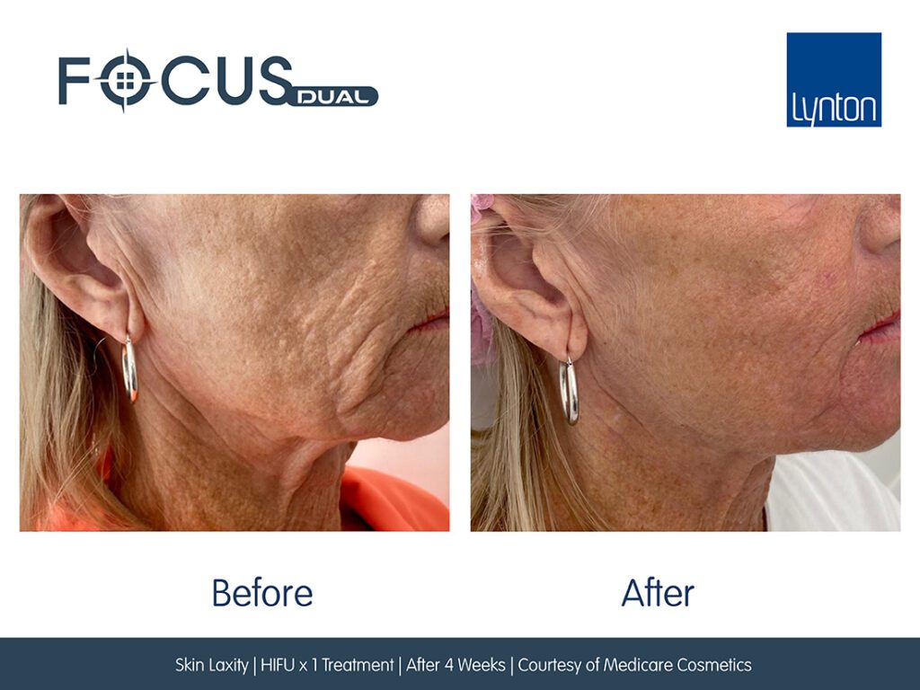 Before and After. Focus Dual. Skin Laxity HIFU Medicare Cosmetics Website 2