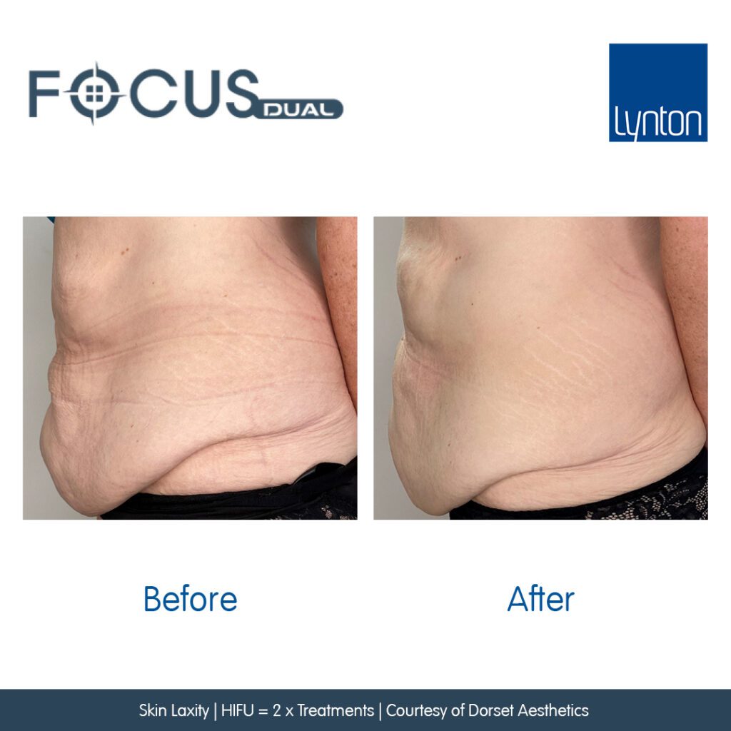 Before and After. Focus Dual. Skin Laxity. HIFU. Dorset Aesthetics