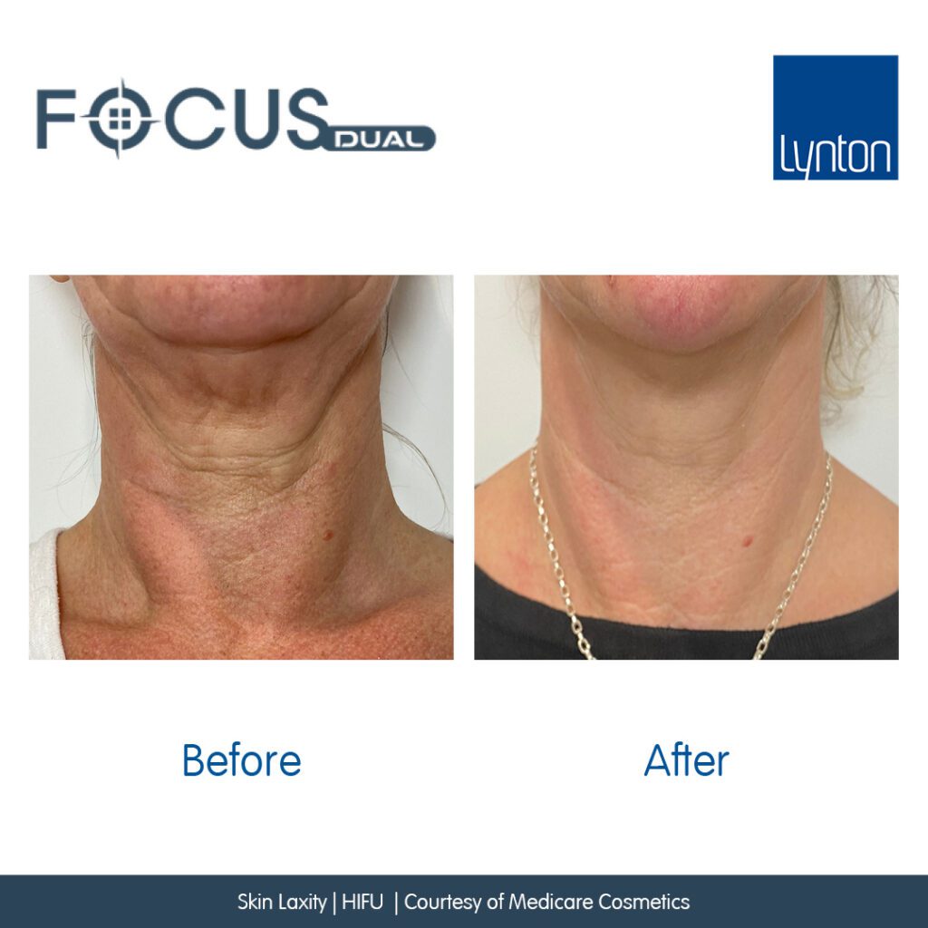 Before and After. Focus Dual. Skin Laxity. HIFU. Medicare Cosmetics