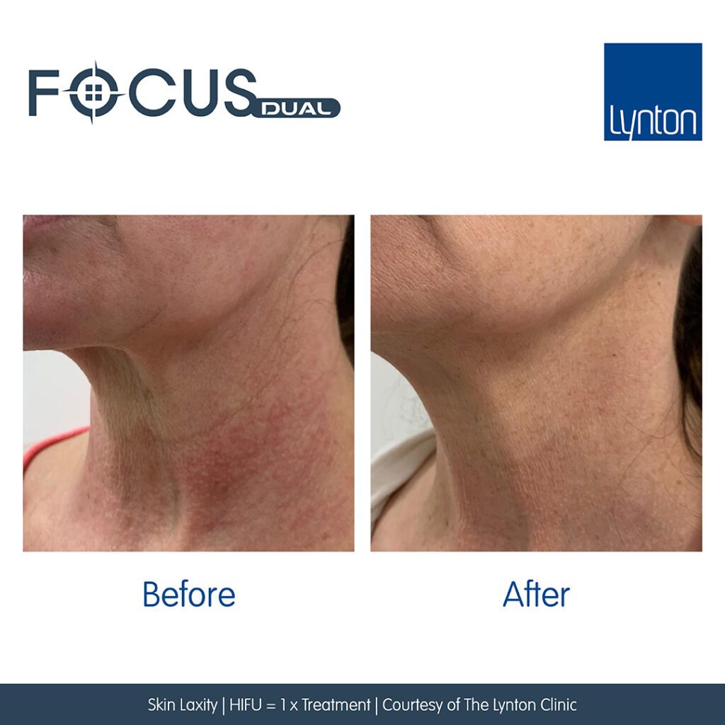 Before and After. Focus Dual. Skin Laxity. HIFU. The Lynton Clinic. Social Media