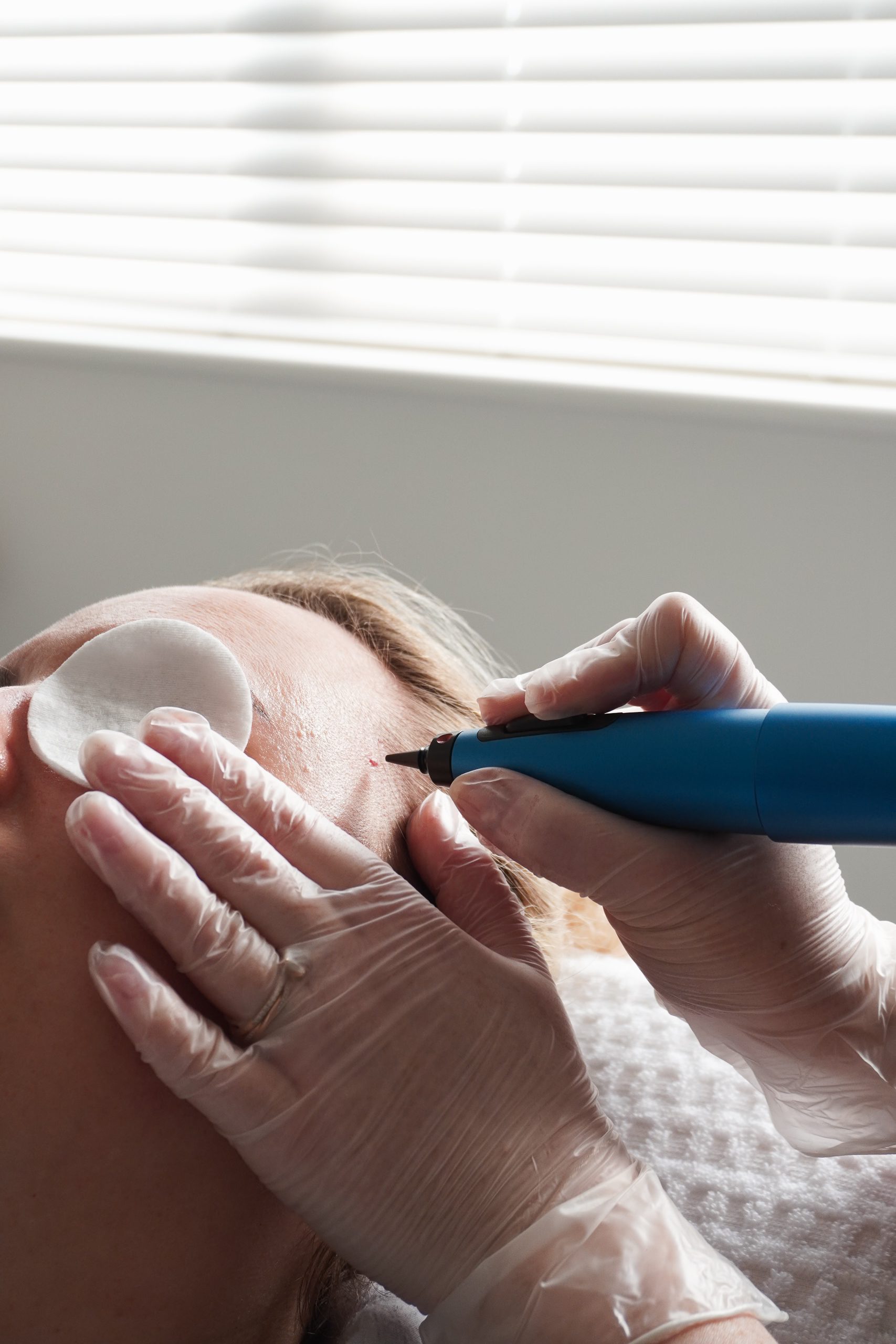 Skin Tag removal in Surrey using Cryopen