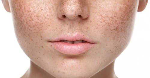 Pigmentation treatment in Surrey