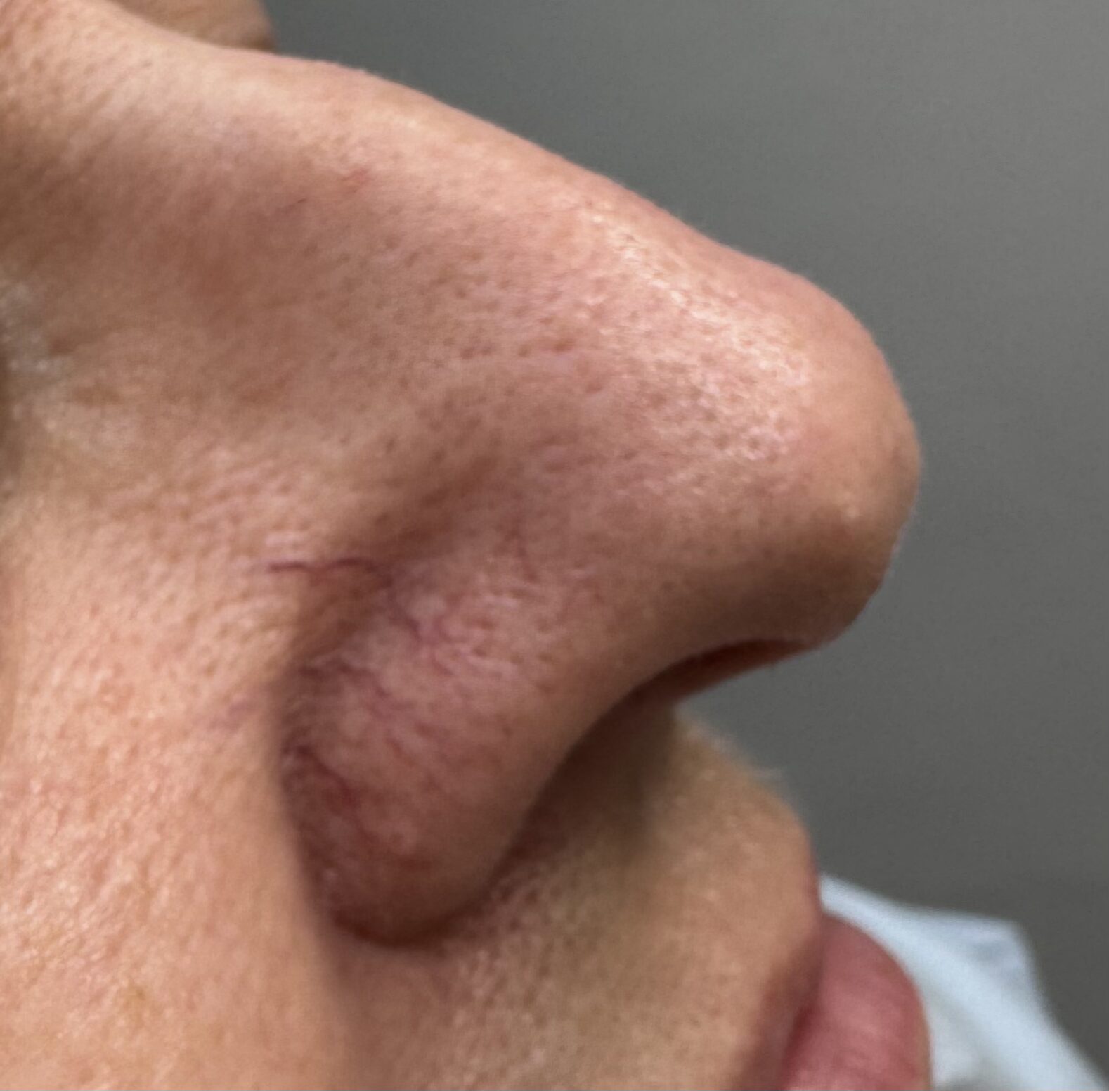 Thread Vein Removal in West Byfleet
