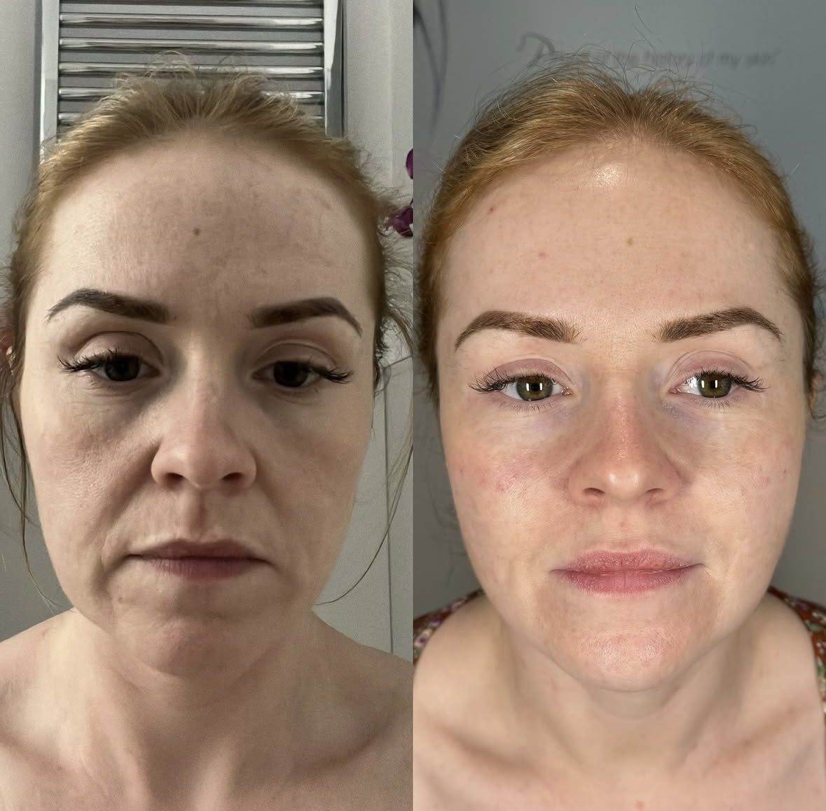 cheek filler in surrey